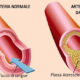 Le pareti arteriose e la formazione delle placche aterosclerotiche