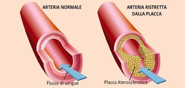 Le pareti arteriose e la formazione delle placche aterosclerotiche